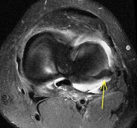 Figure 5 for case Unstable lateral meniscus flap tear